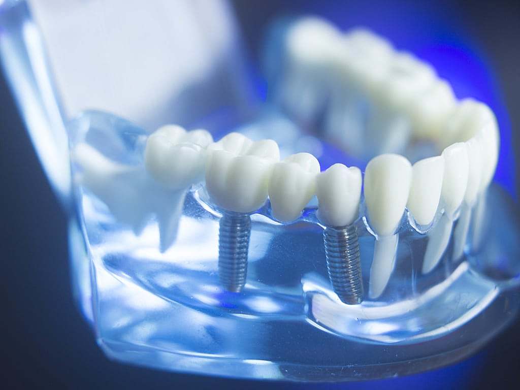 Implant dentaire Lyon : quels sont les types utilisés ?